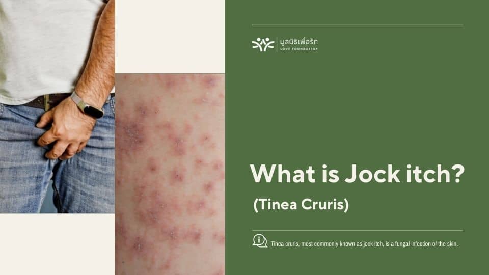 Jock Itch (Tinea Cruris): Treatment and Prevention